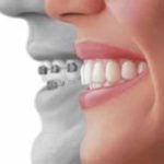 apparecchio trasparente - Studio Dentistico Bernasconi