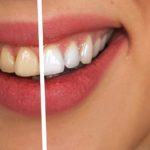 sbiancamento dentale - Studio dentistico Bernasconi | Dentista Saronno