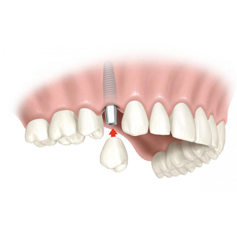 implantologia - Studio Dentistico Bernasconi